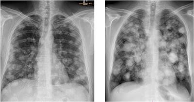 Severe Complications in Testicular Germ Cell Tumors: The Choriocarcinoma Syndrome